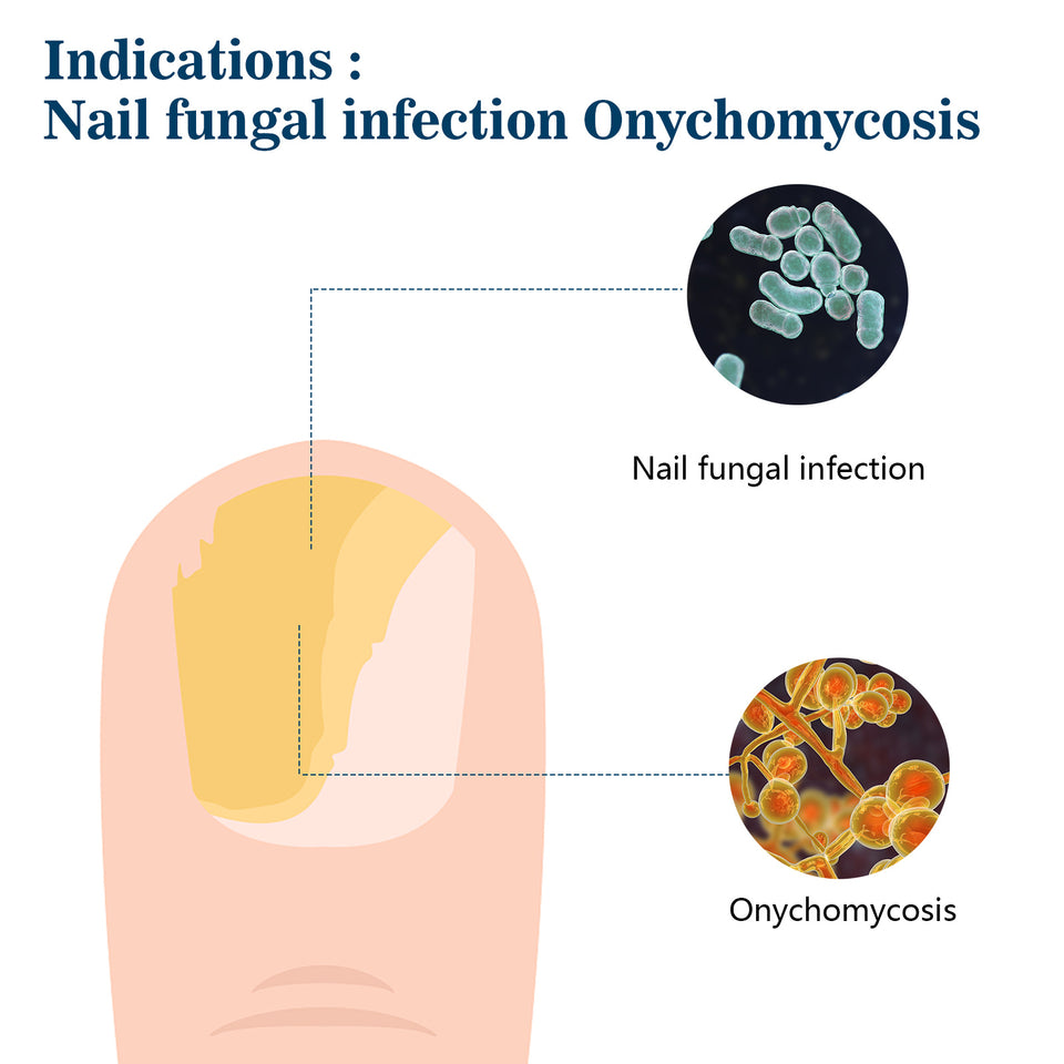 Fingernail Fungus Removal Light Therapy Treatment LLLT Nail